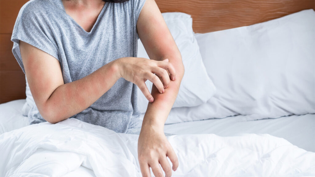 Bed Bugs